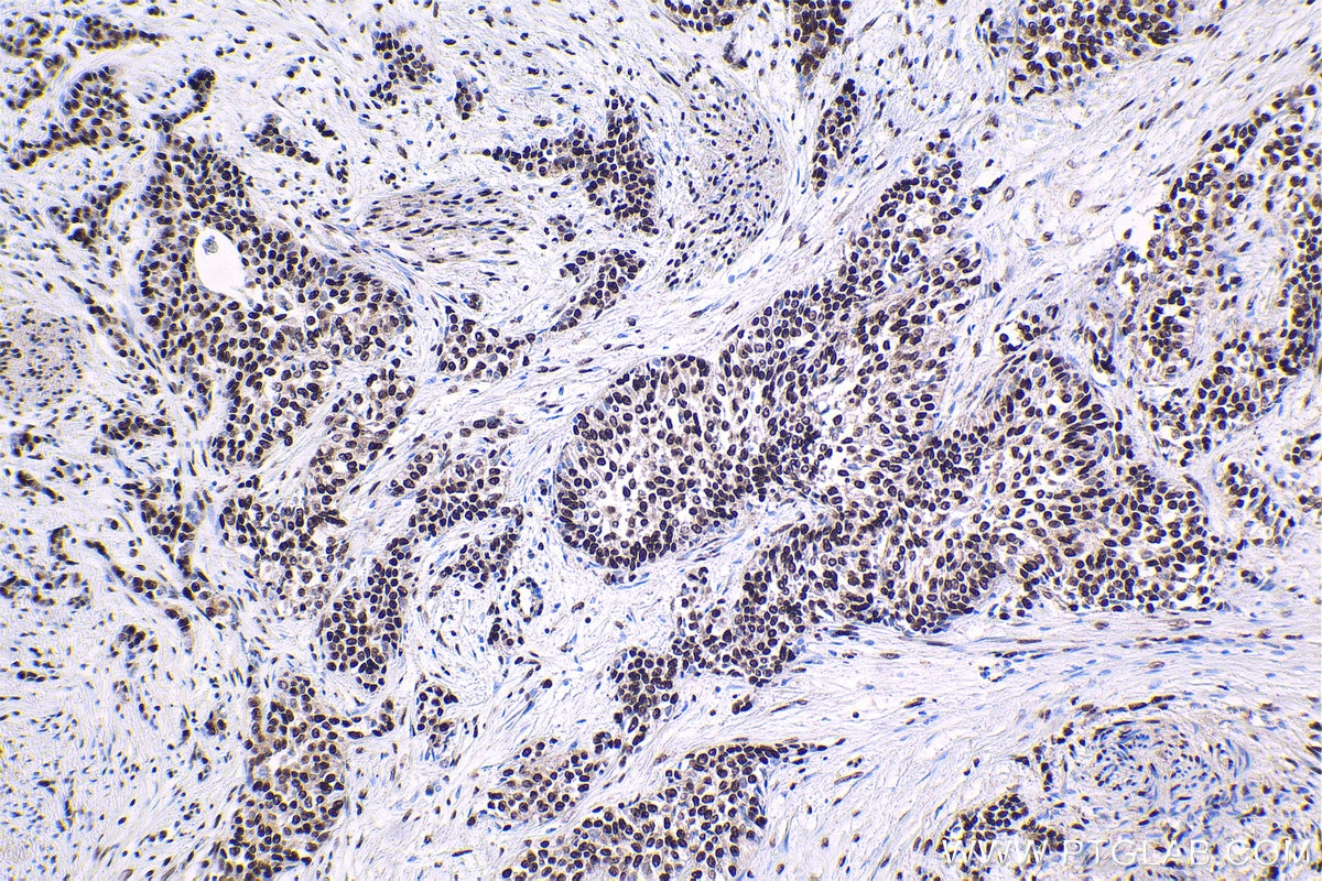 Immunohistochemical analysis of paraffin-embedded human urothelial carcinoma tissue slide using KHC1669 (SP3 IHC Kit).