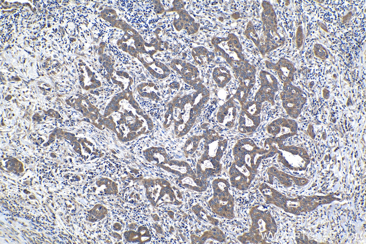 Immunohistochemical analysis of paraffin-embedded human lung cancer tissue slide using KHC1181 (SPDYC IHC Kit).