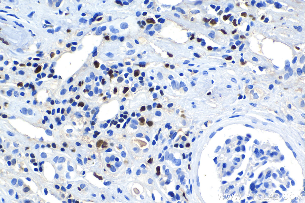 Immunohistochemical analysis of paraffin-embedded human renal cell carcinoma tissue slide using KHC1149 (SPI1 IHC Kit).
