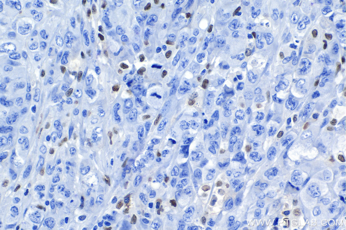 Immunohistochemical analysis of paraffin-embedded human lymphoma tissue slide using KHC1149 (SPI1 IHC Kit).
