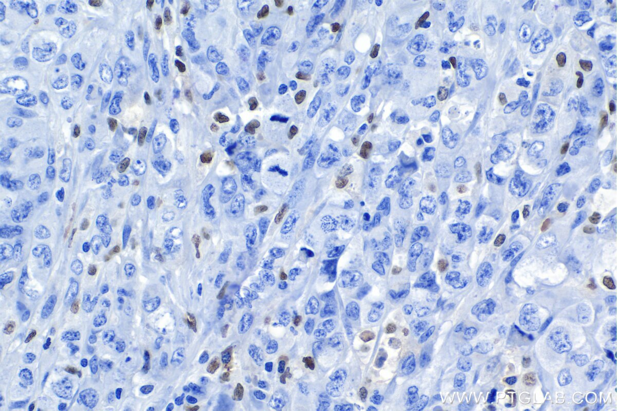 Immunohistochemical analysis of paraffin-embedded human lymphoma tissue slide using KHC1149 (SPI1 IHC Kit).