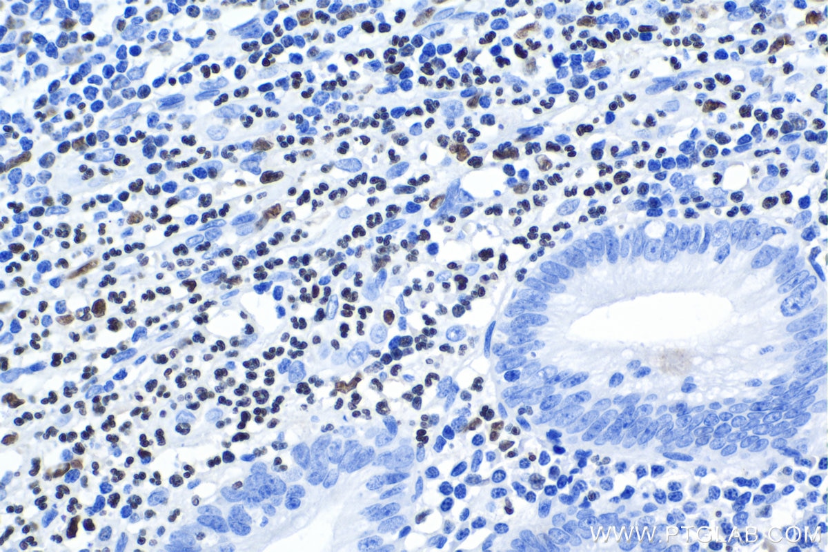 Immunohistochemical analysis of paraffin-embedded human appendicitis tissue slide using KHC1149 (SPI1 IHC Kit).