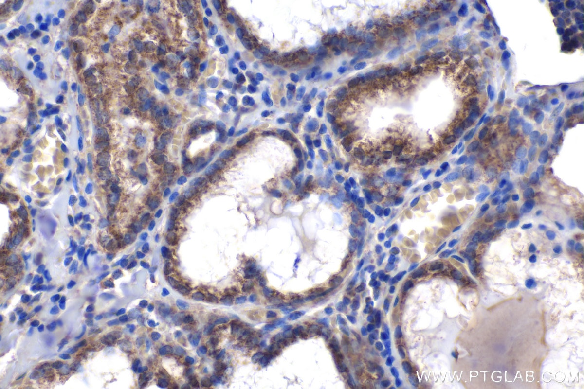 Immunohistochemical analysis of paraffin-embedded human thyroid cancer tissue slide using KHC1668 (SPIB IHC Kit).