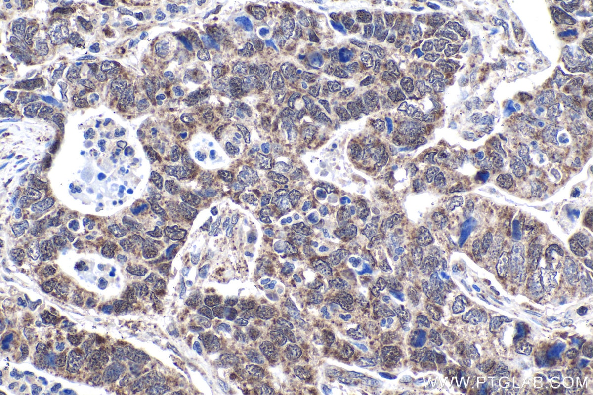 Immunohistochemical analysis of paraffin-embedded human stomach cancer tissue slide using KHC1668 (SPIB IHC Kit).