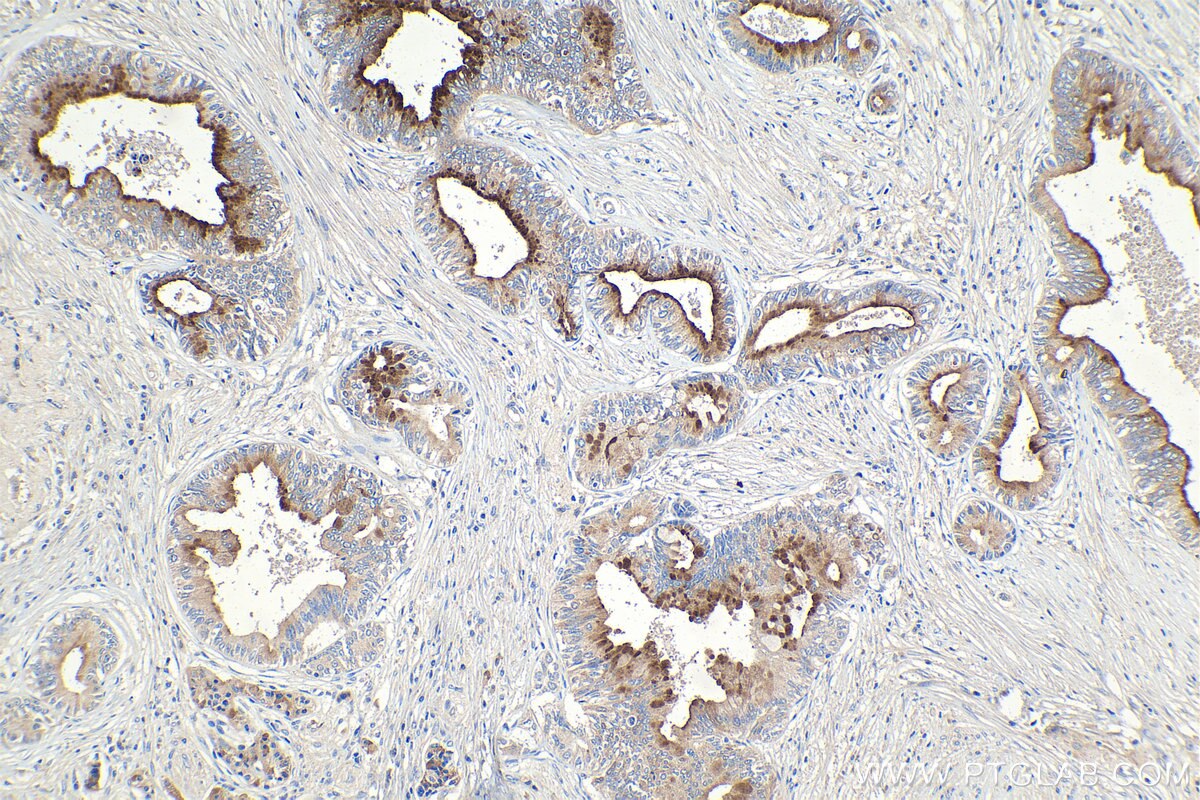 Immunohistochemical analysis of paraffin-embedded human pancreas cancer tissue slide using KHC1105 (SPINK1 IHC Kit).