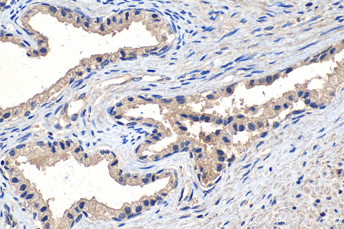 Immunohistochemical analysis of paraffin-embedded human prostate cancer tissue slide using KHC1105 (SPINK1 IHC Kit).