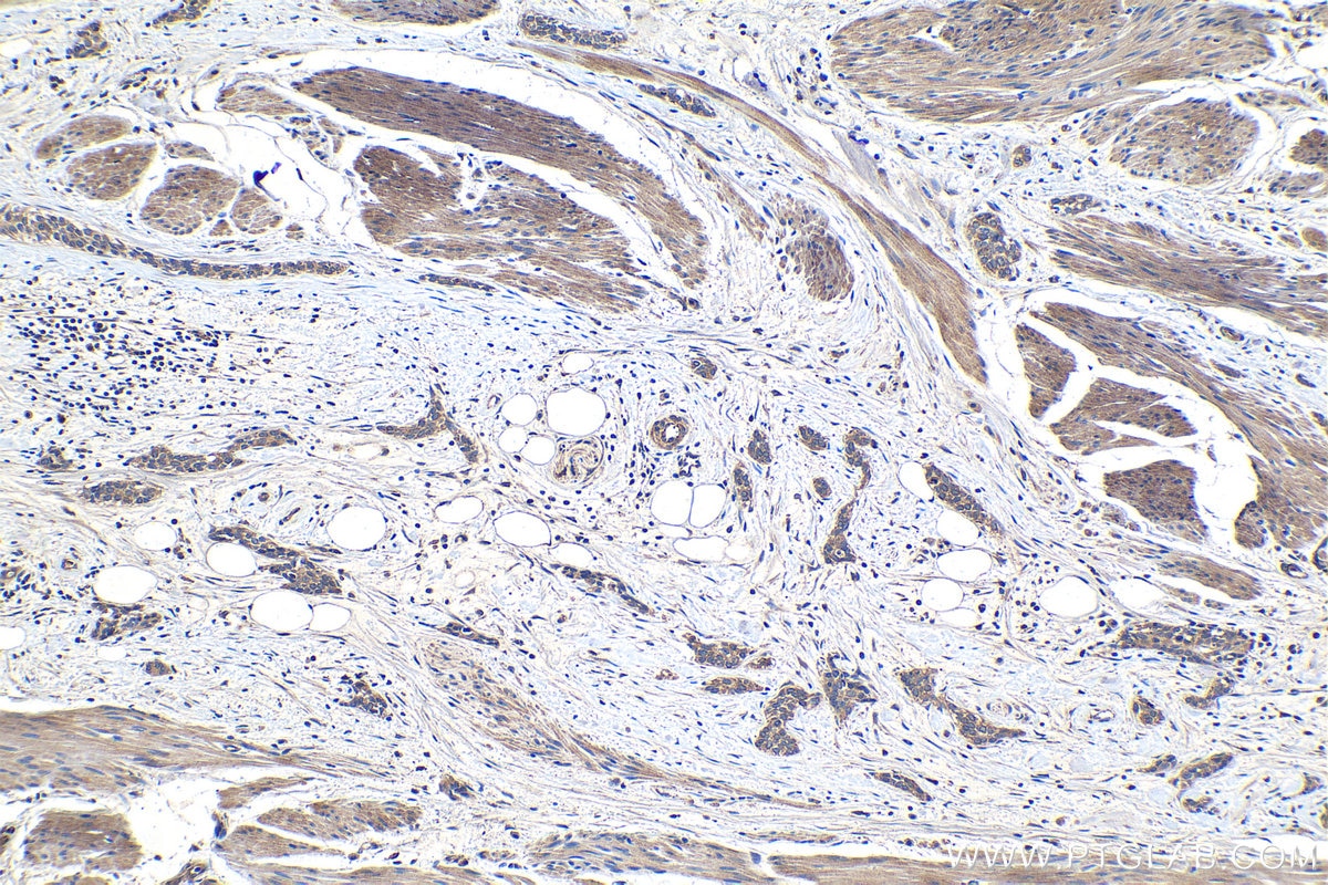 Immunohistochemical analysis of paraffin-embedded human urothelial carcinoma tissue slide using KHC1105 (SPINK1 IHC Kit).