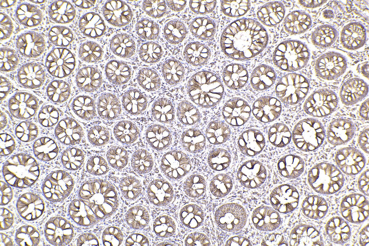Immunohistochemical analysis of paraffin-embedded human rectal cancer tissue slide using KHC2442 (SPTAN1 IHC Kit).