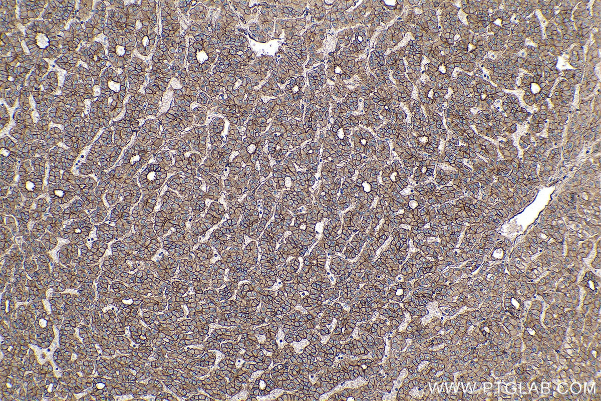 Immunohistochemical analysis of paraffin-embedded human liver cancer tissue slide using KHC0283 (SPTBN1 IHC Kit).