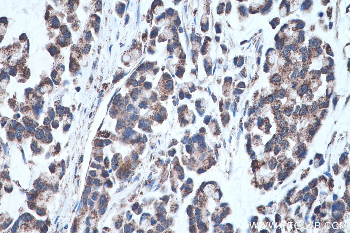 Immunohistochemical analysis of paraffin-embedded human colon cancer tissue slide using KHC0466 (SQRDL IHC Kit).
