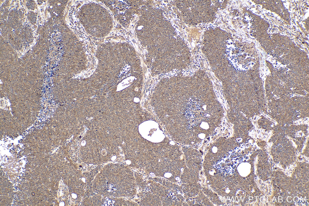 Immunohistochemical analysis of paraffin-embedded human lung cancer tissue slide using KHC1587 (SREBF1 IHC Kit).