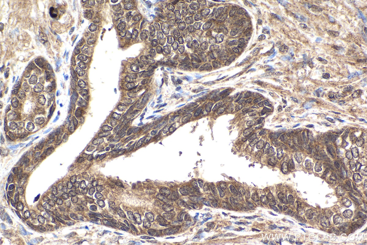 Immunohistochemical analysis of paraffin-embedded human prostate cancer tissue slide using KHC1587 (SREBF1 IHC Kit).