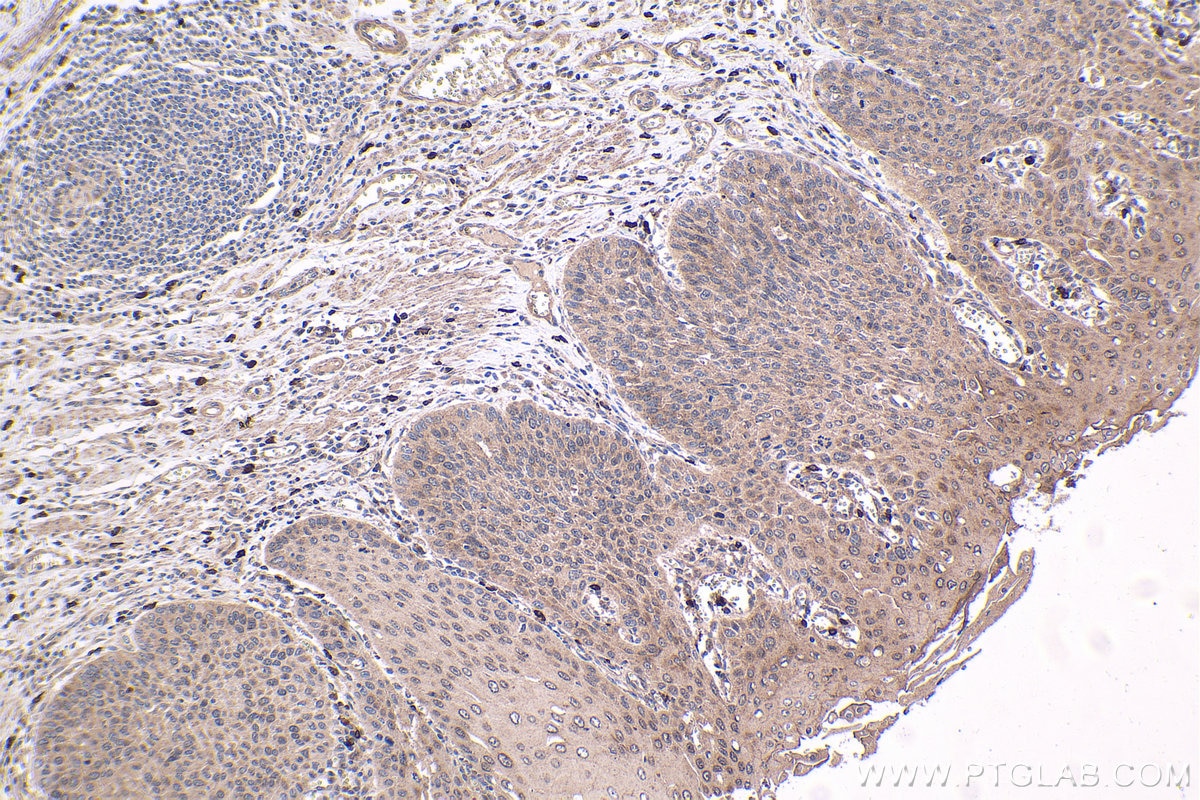 Immunohistochemical analysis of paraffin-embedded human oesophagus cancer tissue slide using KHC1689 (SREBF2 IHC Kit).