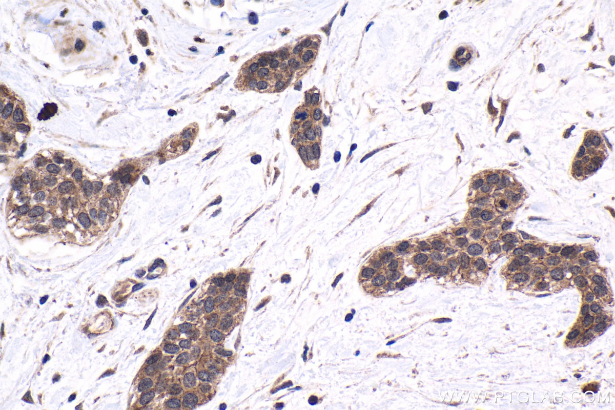 Immunohistochemical analysis of paraffin-embedded human urothelial carcinoma tissue slide using KHC1689 (SREBF2 IHC Kit).