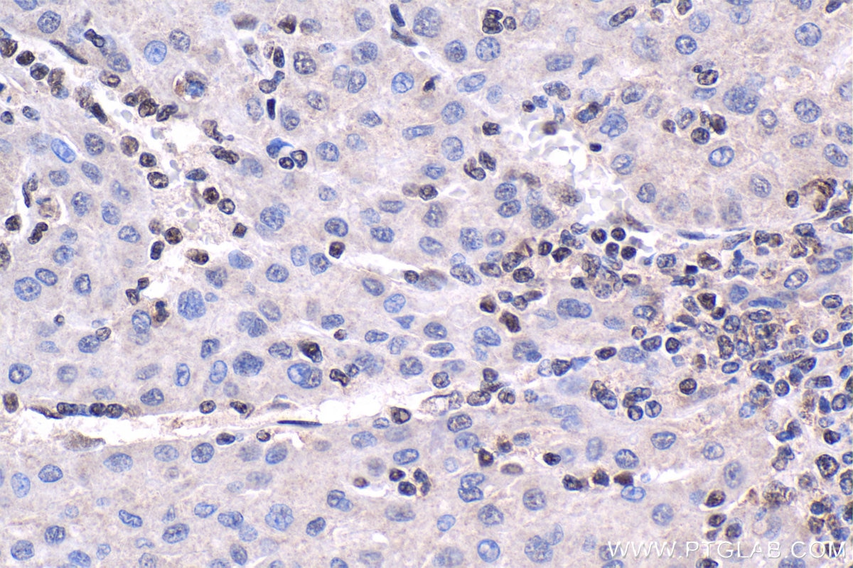 Immunohistochemical analysis of paraffin-embedded human liver cancer tissue slide using KHC1526 (SRF IHC Kit).