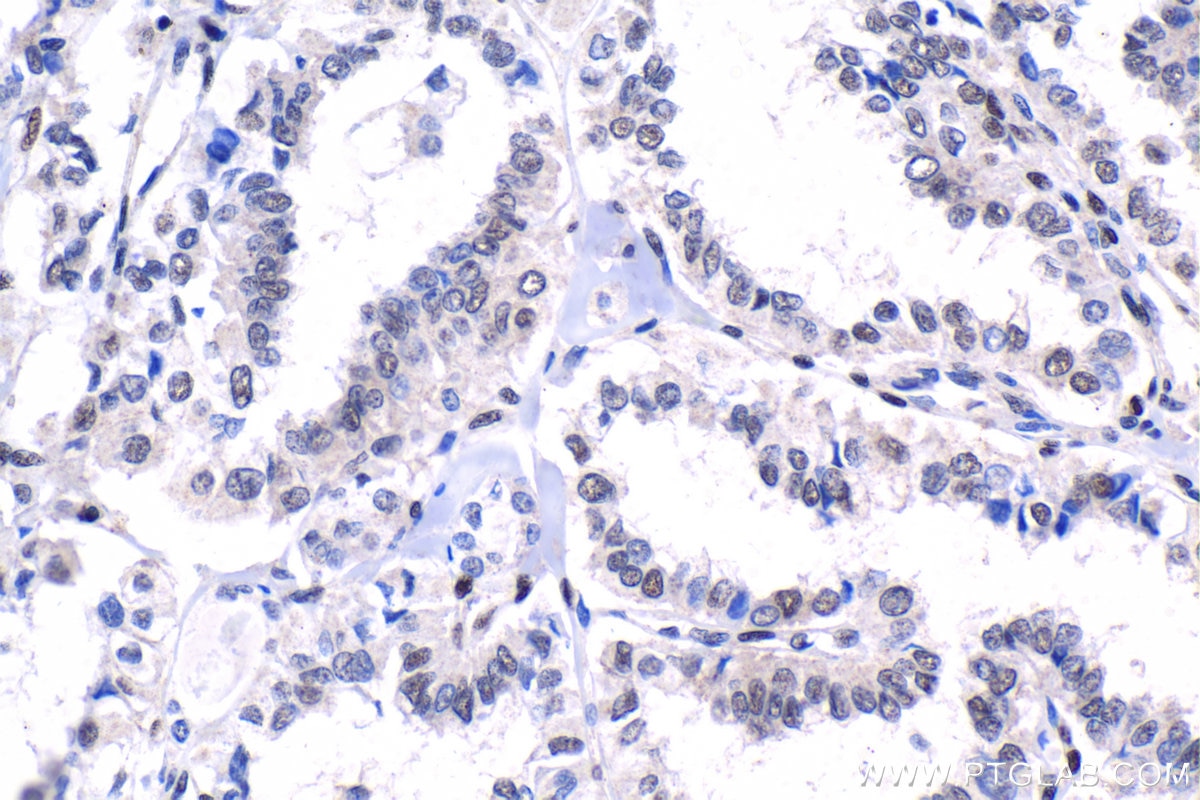 Immunohistochemical analysis of paraffin-embedded human thyroid cancer tissue slide using KHC1526 (SRF IHC Kit).