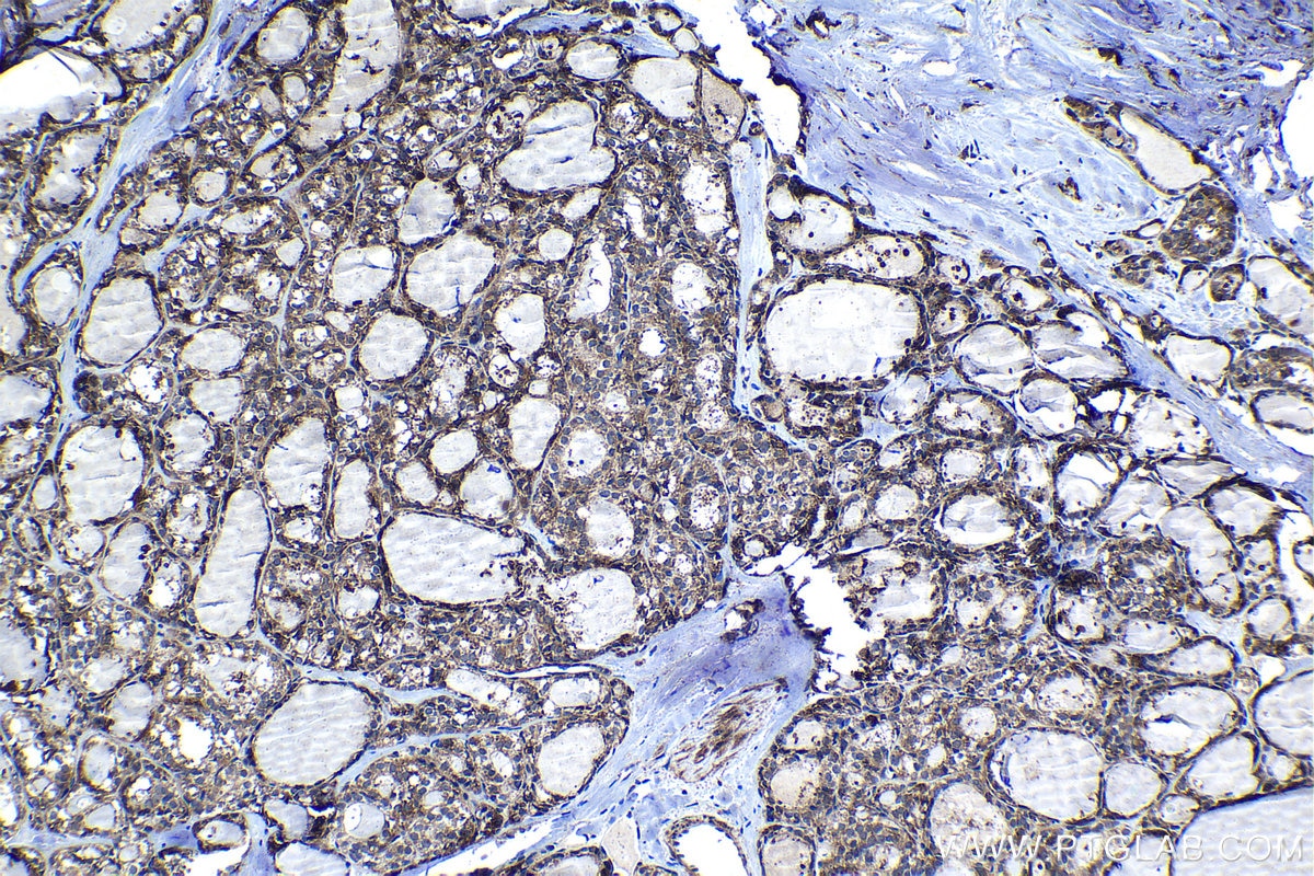 Immunohistochemical analysis of paraffin-embedded human thyroid cancer tissue slide using KHC1283 (SRGAP1 IHC Kit).