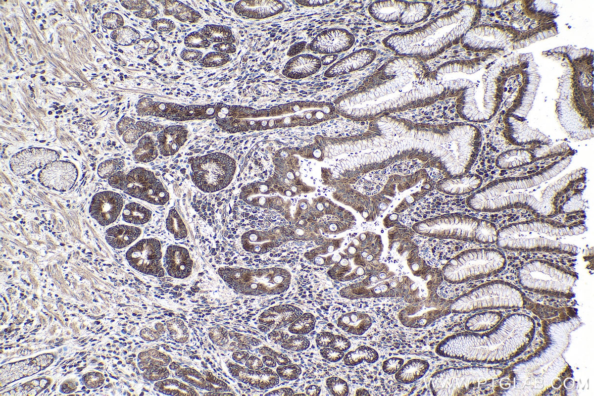 Immunohistochemical analysis of paraffin-embedded human stomach cancer tissue slide using KHC1032 (SRPK1 IHC Kit).