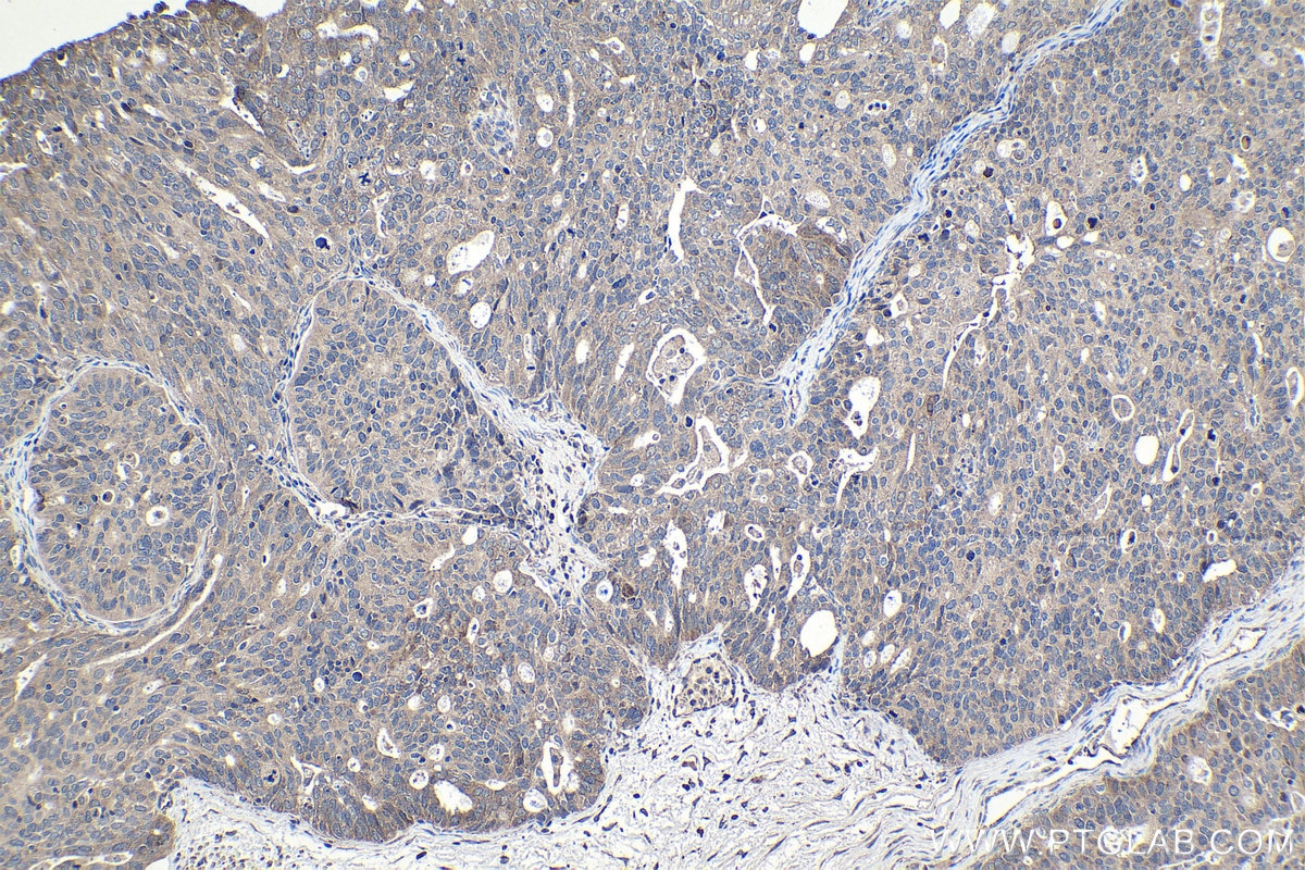 Immunohistochemical analysis of paraffin-embedded human ovary tumor tissue slide using KHC1032 (SRPK1 IHC Kit).
