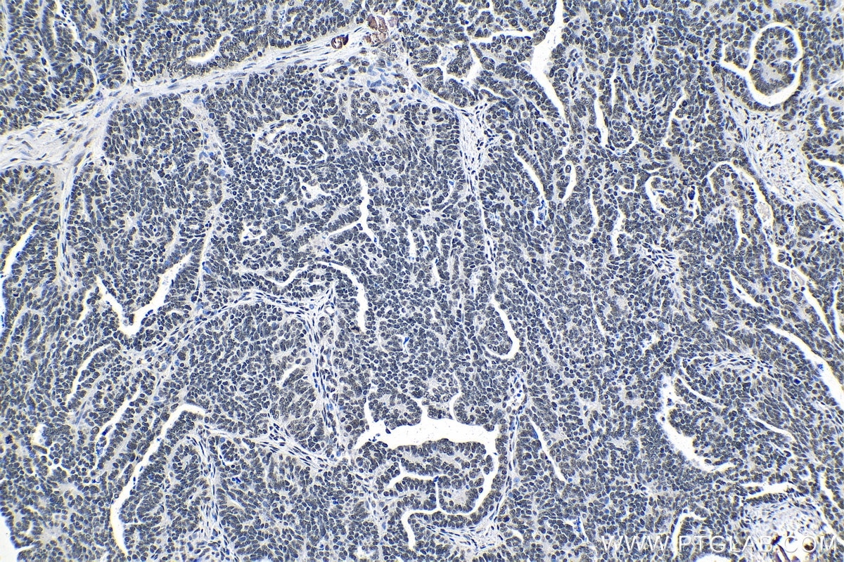 Immunohistochemical analysis of paraffin-embedded human ovary tumor tissue slide using KHC1396 (SRSF1 IHC Kit).