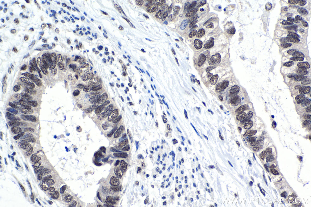 Immunohistochemical analysis of paraffin-embedded human urothelial carcinoma tissue slide using KHC1475 (SRSF10 IHC Kit).