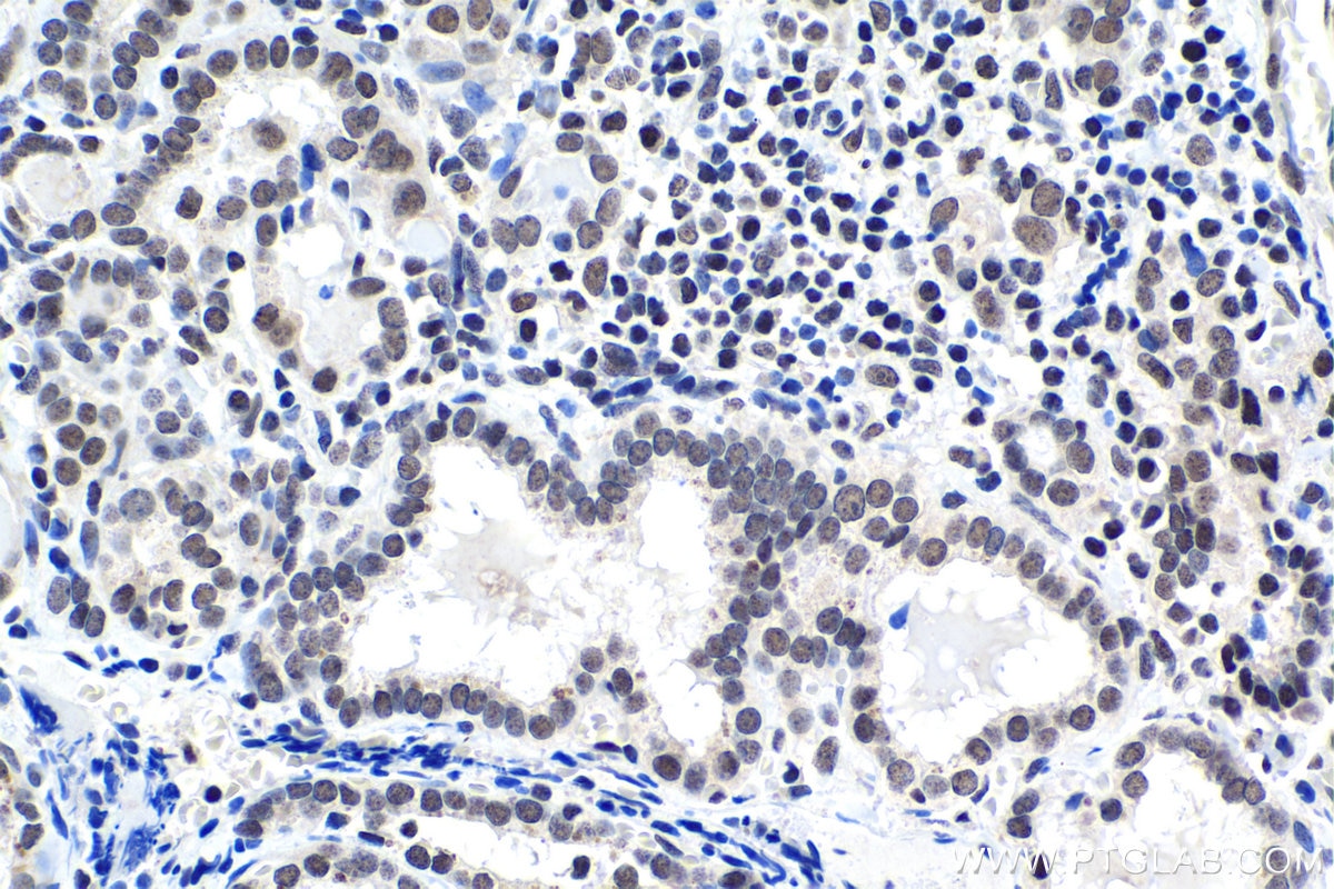 Immunohistochemical analysis of paraffin-embedded human thyroid cancer tissue slide using KHC1475 (SRSF10 IHC Kit).