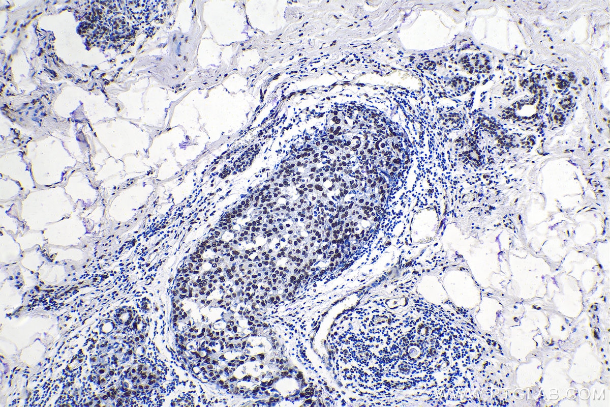 Immunohistochemical analysis of paraffin-embedded human breast cancer tissue slide using KHC1390 (SRSF11 IHC Kit).