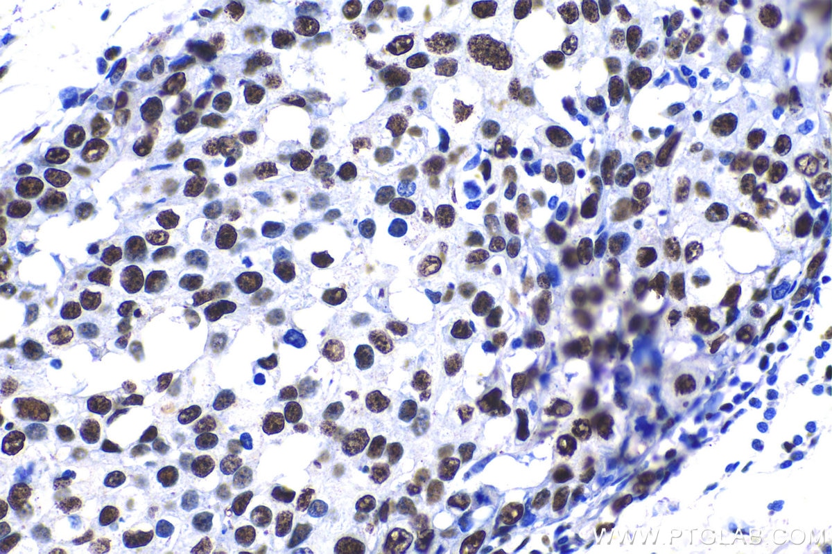Immunohistochemical analysis of paraffin-embedded human breast cancer tissue slide using KHC1390 (SRSF11 IHC Kit).