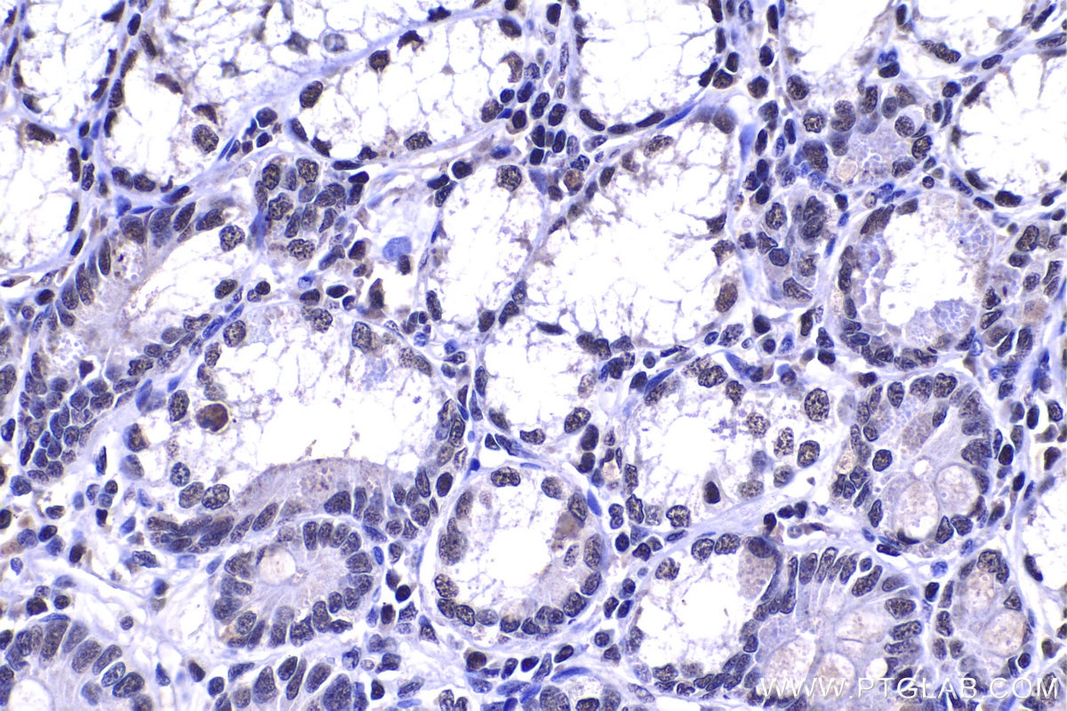 Immunohistochemical analysis of paraffin-embedded human stomach cancer tissue slide using KHC1390 (SRSF11 IHC Kit).