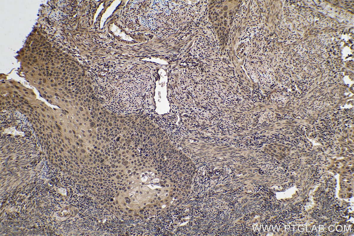 Immunohistochemical analysis of paraffin-embedded human cervical cancer tissue slide using KHC0730 (SRSF3 IHC Kit).
