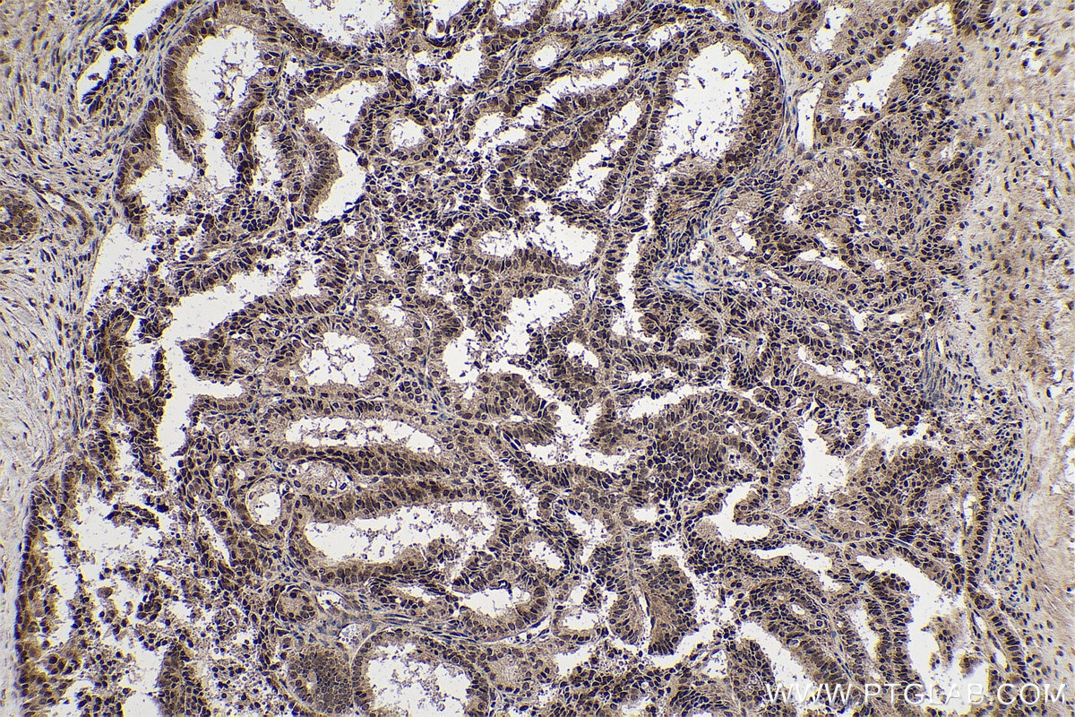 Immunohistochemical analysis of paraffin-embedded human ovary tumor tissue slide using KHC0730 (SRSF3 IHC Kit).