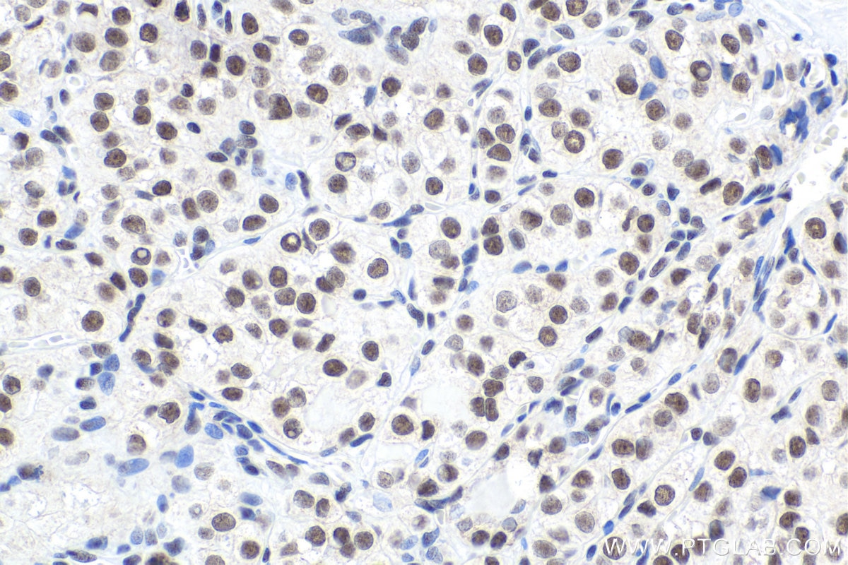 Immunohistochemical analysis of paraffin-embedded human thyroid cancer tissue slide using KHC1762 (SRSF7/SFRS7 IHC Kit).