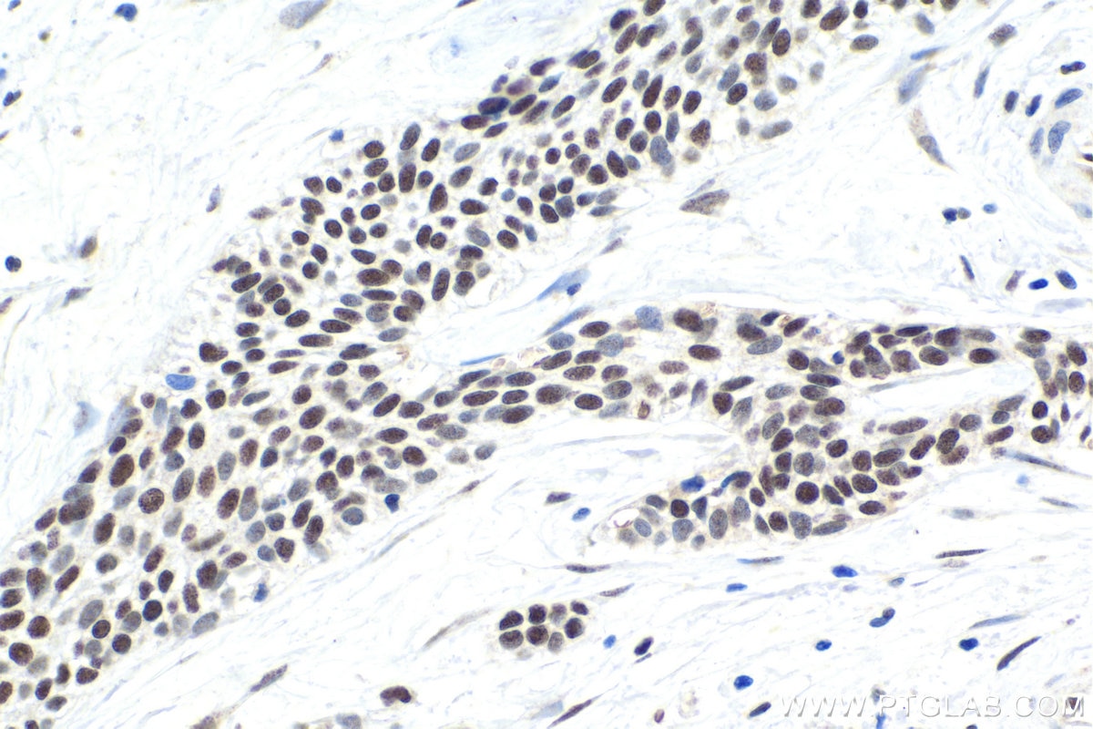 Immunohistochemical analysis of paraffin-embedded human urothelial carcinoma tissue slide using KHC1707 (SRSF9/SFRS9 IHC Kit).