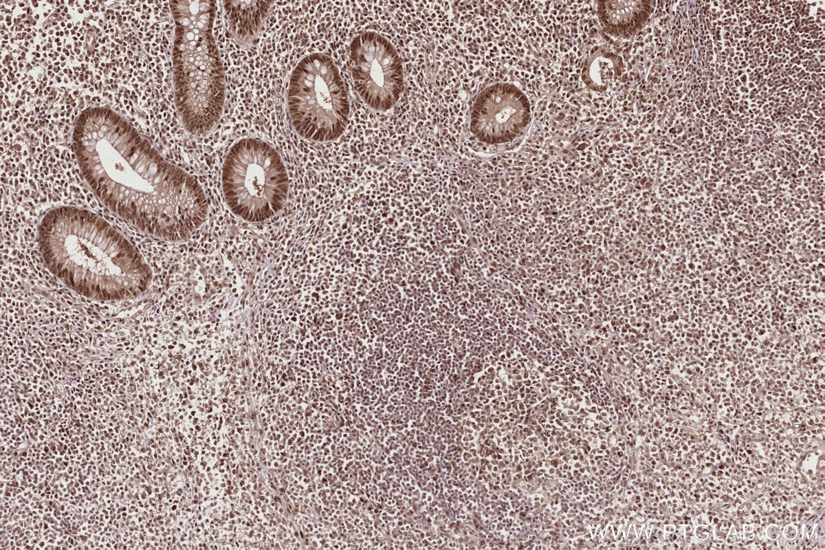 Immunohistochemical analysis of paraffin-embedded human appendicitis tissue slide using KHC2722 (SSH3 IHC Kit).