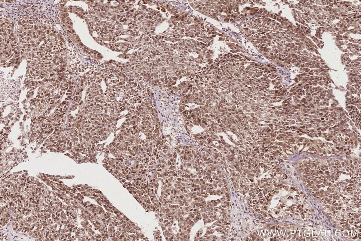 Immunohistochemical analysis of paraffin-embedded human ovary cancer tissue slide using KHC2722 (SSH3 IHC Kit).