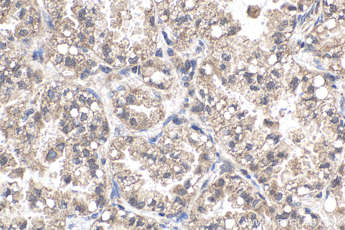 Immunohistochemical analysis of paraffin-embedded human lung cancer tissue slide using KHC1952 (SSU72 IHC Kit).