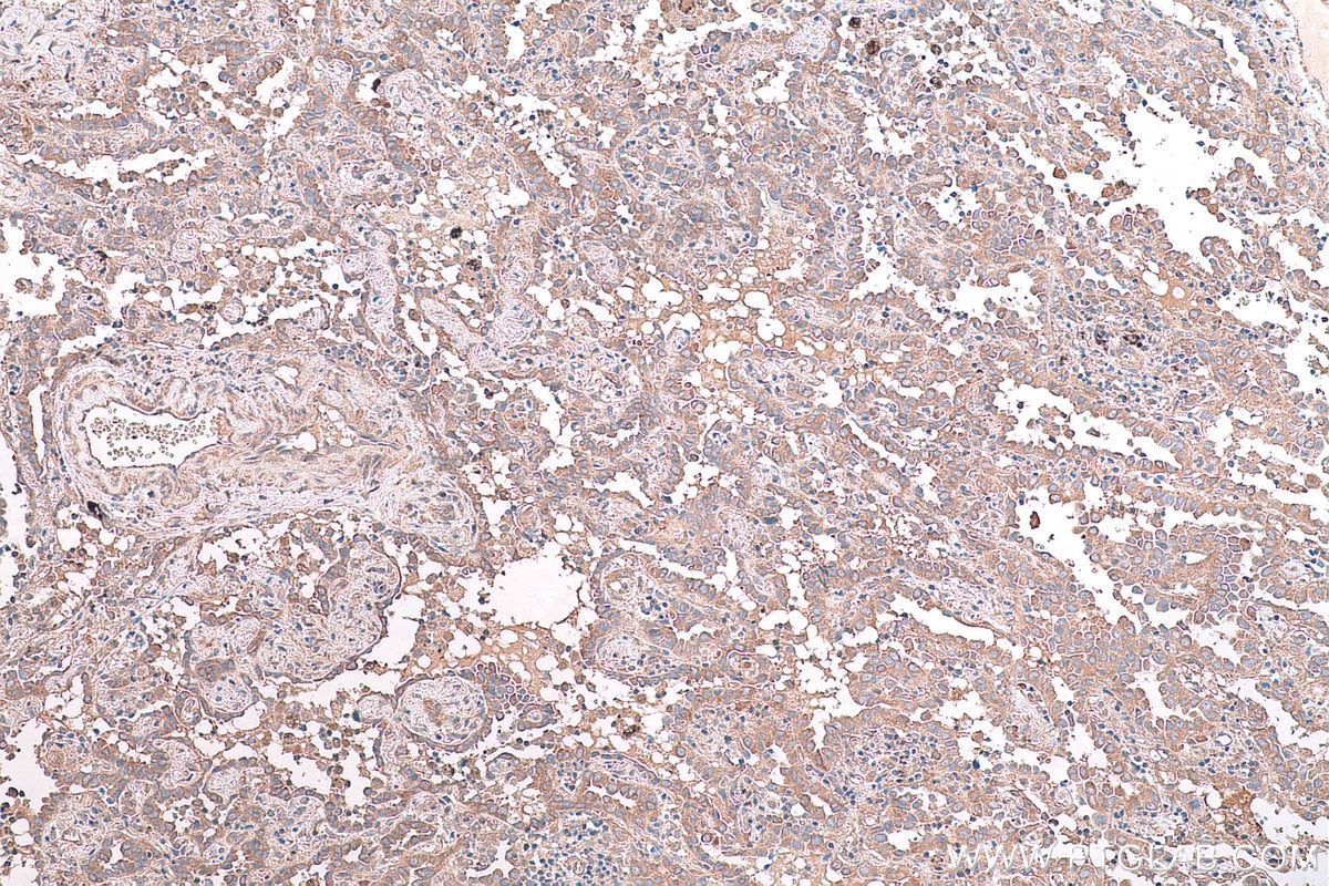 Immunohistochemical analysis of paraffin-embedded human lung cancer tissue slide using KHC0849 (ST13 IHC Kit).