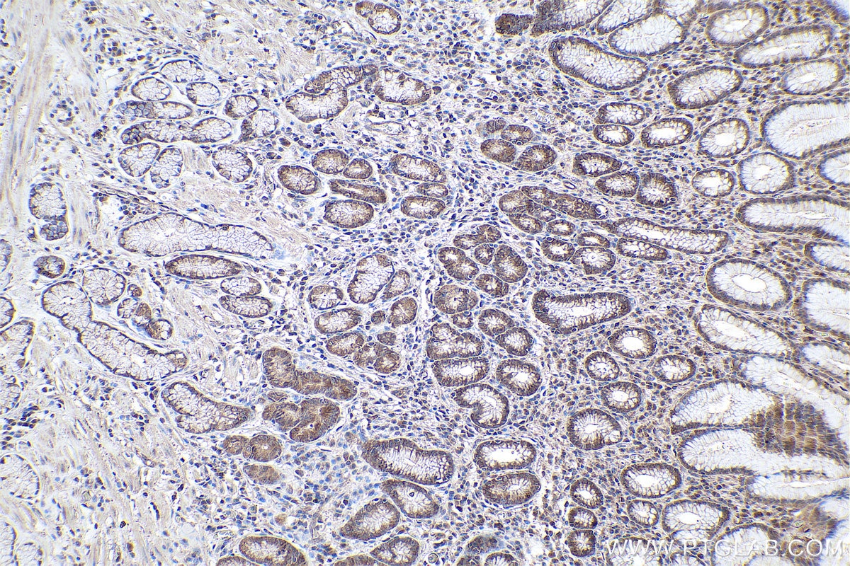 Immunohistochemical analysis of paraffin-embedded human stomach cancer tissue slide using KHC0849 (ST13 IHC Kit).