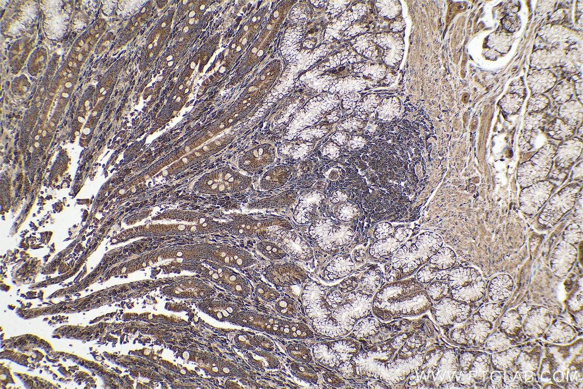 Immunohistochemical analysis of paraffin-embedded human stomach cancer tissue slide using KHC0642 (ST6GAL1 IHC Kit).