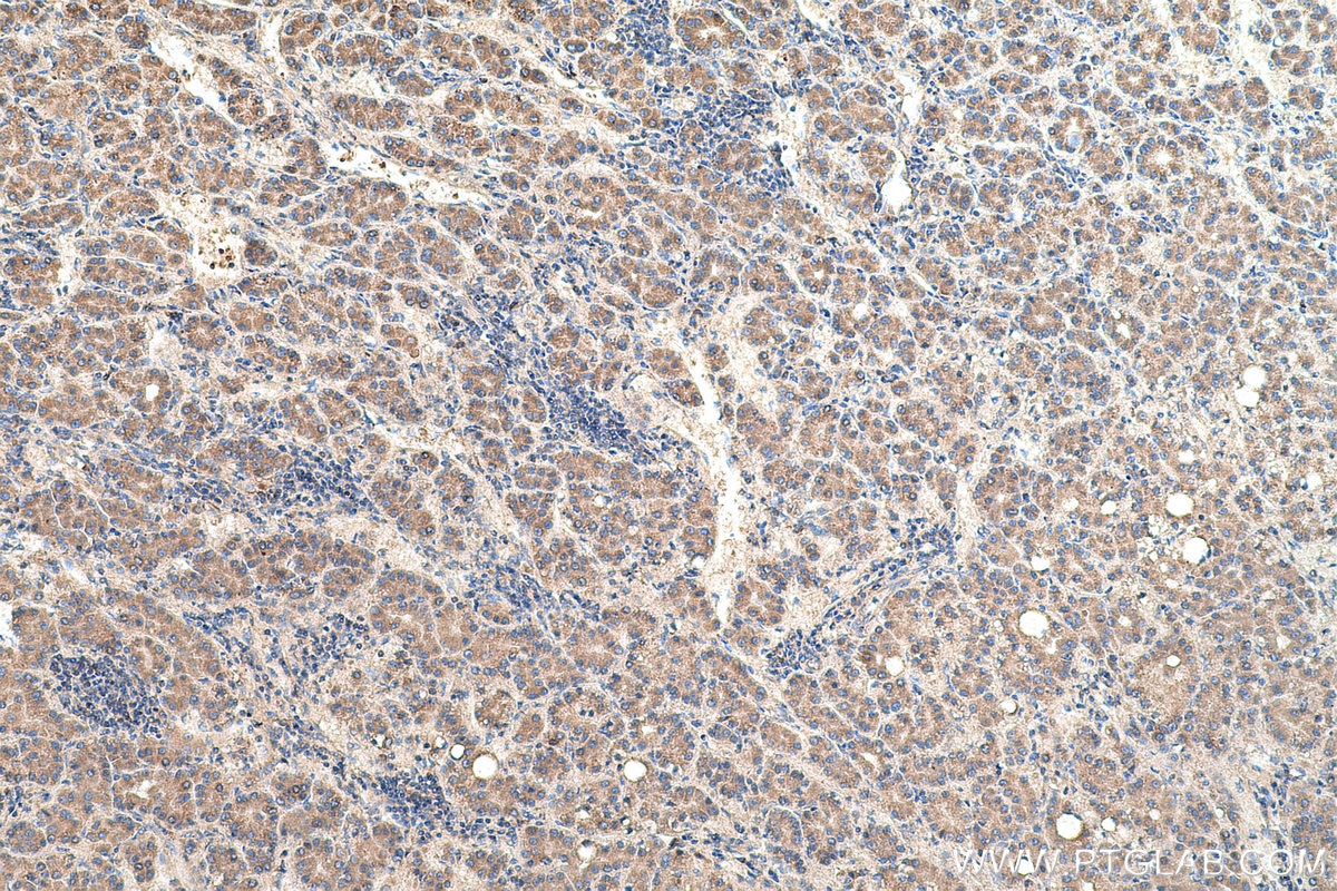 Immunohistochemical analysis of paraffin-embedded human liver cancer tissue slide using KHC0642 (ST6GAL1 IHC Kit).