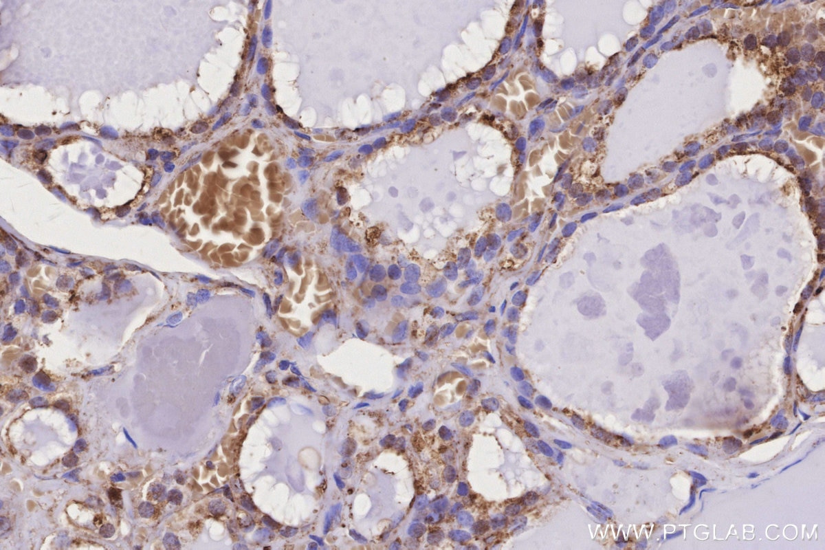 Immunohistochemical analysis of paraffin-embedded human thyroid cancer tissue slide using KHC3157 (STARD3NL IHC Kit).