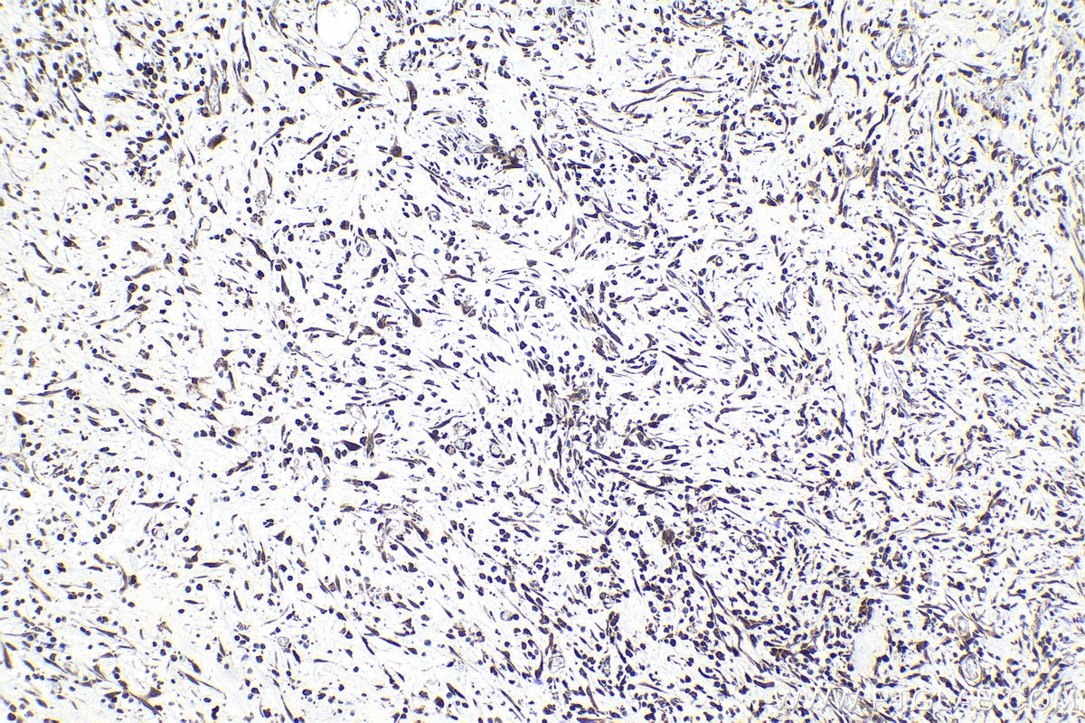 Immunohistochemical analysis of paraffin-embedded human colon cancer tissue slide using KHC1036 (STAT1 IHC Kit).