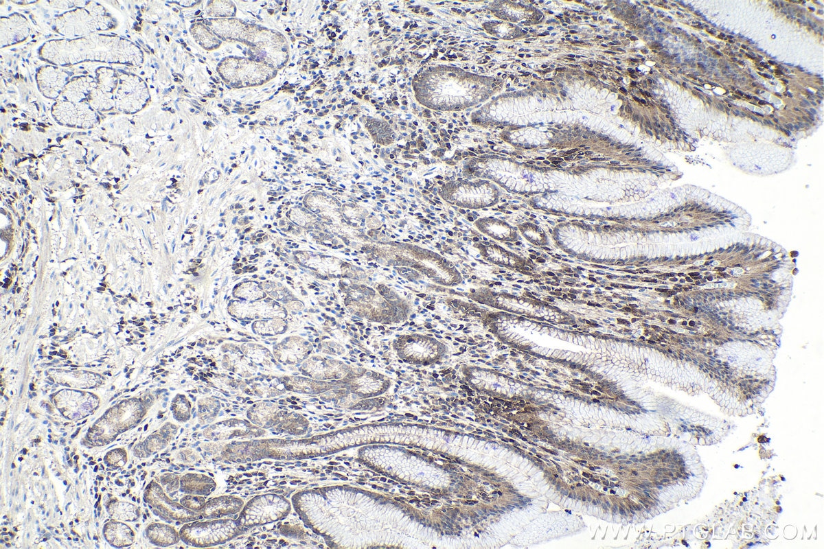 Immunohistochemical analysis of paraffin-embedded human stomach cancer tissue slide using KHC1036 (STAT1 IHC Kit).