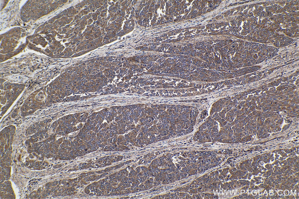 Immunohistochemical analysis of paraffin-embedded human oesophagus cancer tissue slide using KHC1622 (STAT2 IHC Kit).
