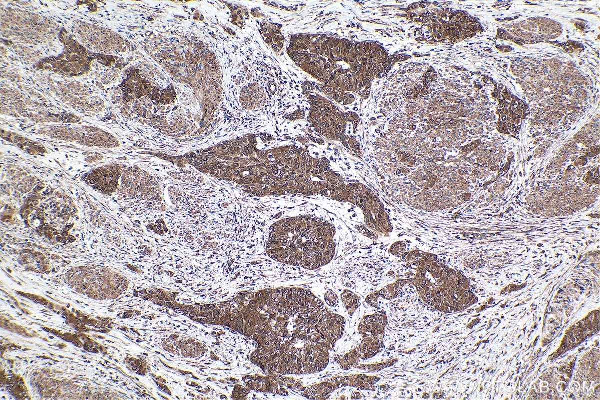 Immunohistochemical analysis of paraffin-embedded human urothelial carcinoma tissue slide using KHC1622 (STAT2 IHC Kit).