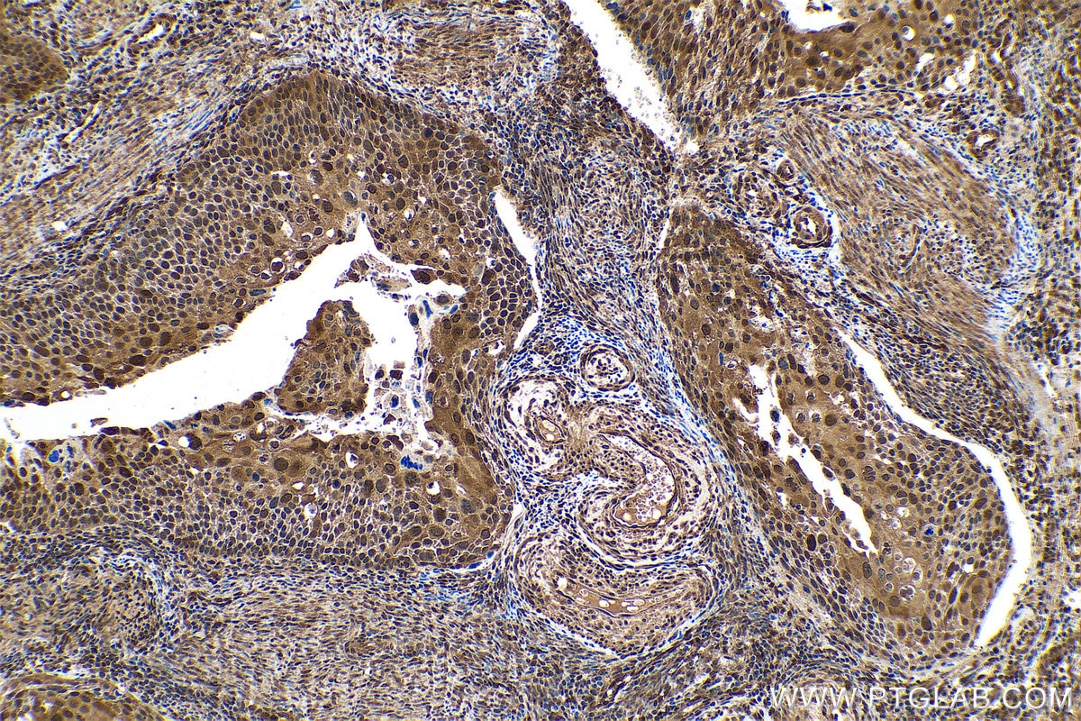 Immunohistochemical analysis of paraffin-embedded human cervical cancer tissue slide using KHC0761 (STAT3 IHC Kit).