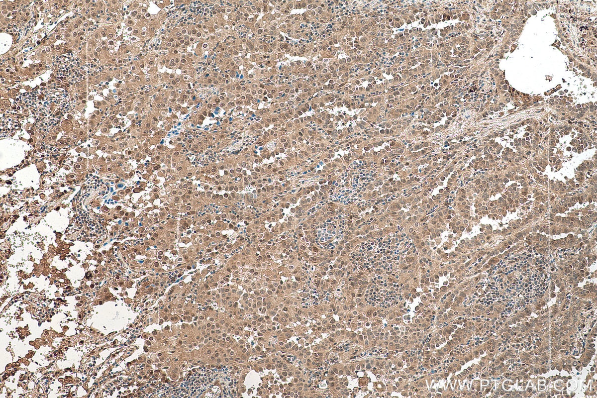 Immunohistochemical analysis of paraffin-embedded human lung cancer tissue slide using KHC0761 (STAT3 IHC Kit).