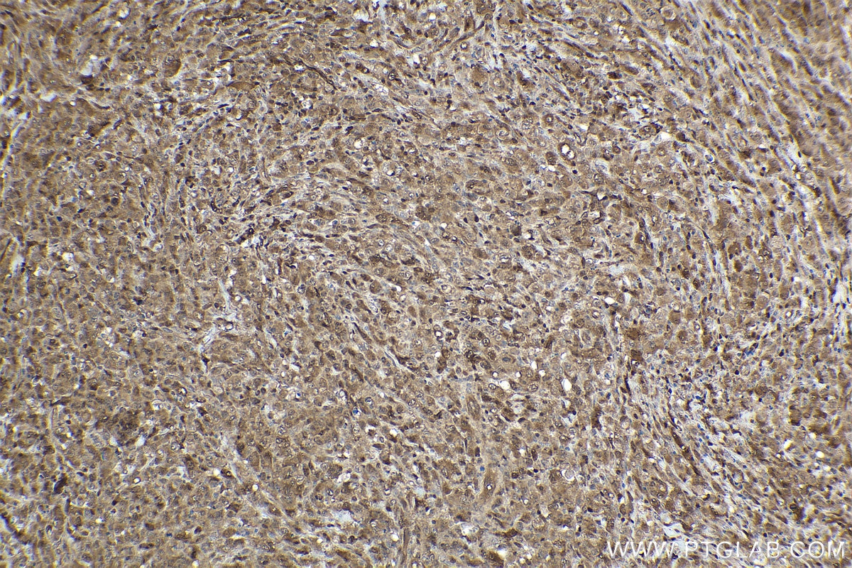 Immunohistochemical analysis of paraffin-embedded human lymphoma tissue slide using KHC1594 (STAT5A IHC Kit).