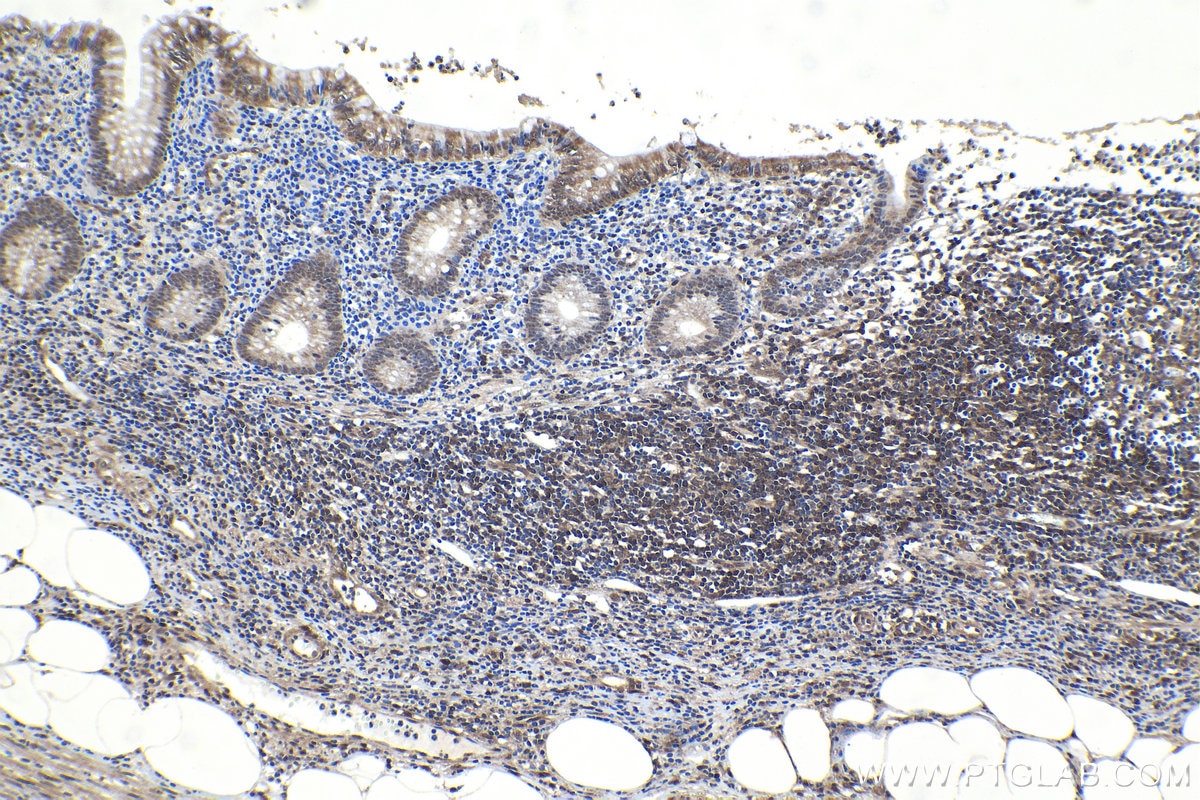 Immunohistochemical analysis of paraffin-embedded human appendicitis tissue slide using KHC1151 (STAT6 IHC Kit).