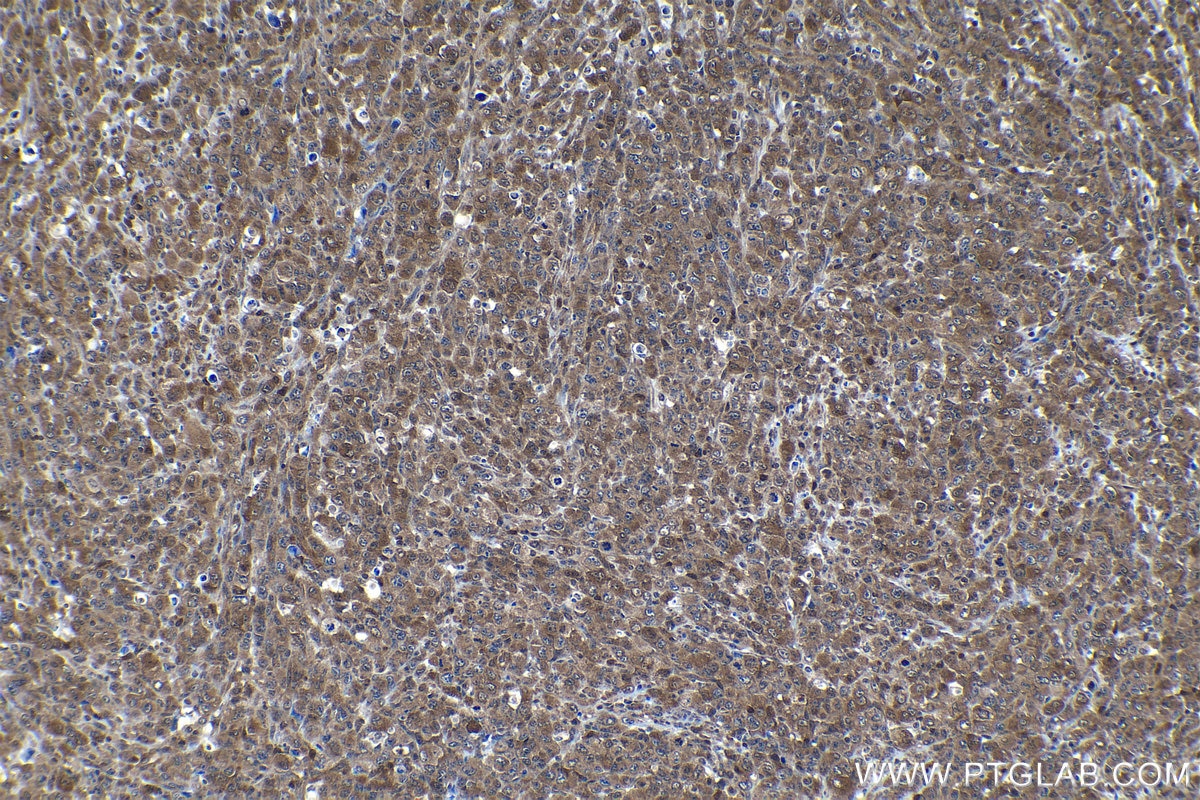 Immunohistochemical analysis of paraffin-embedded human lymphoma tissue slide using KHC1151 (STAT6 IHC Kit).